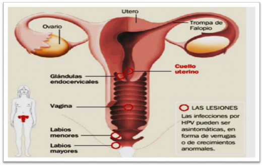 Vista De Cuidados De Las Pacientes Sometidas A Cirugias De Cancer Uterino Reciamuc