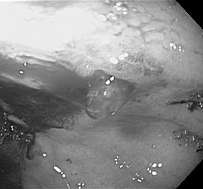 Lesión de Dieulafoy gástrica en la pared anterior del cuerpo proximal