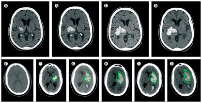 Hematoma intracerebral temporal izquierdo y hemorragia subaracnoidea